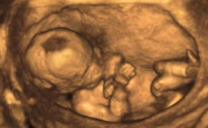 3d_ultrasound_fetus_810_500_75_s_c1